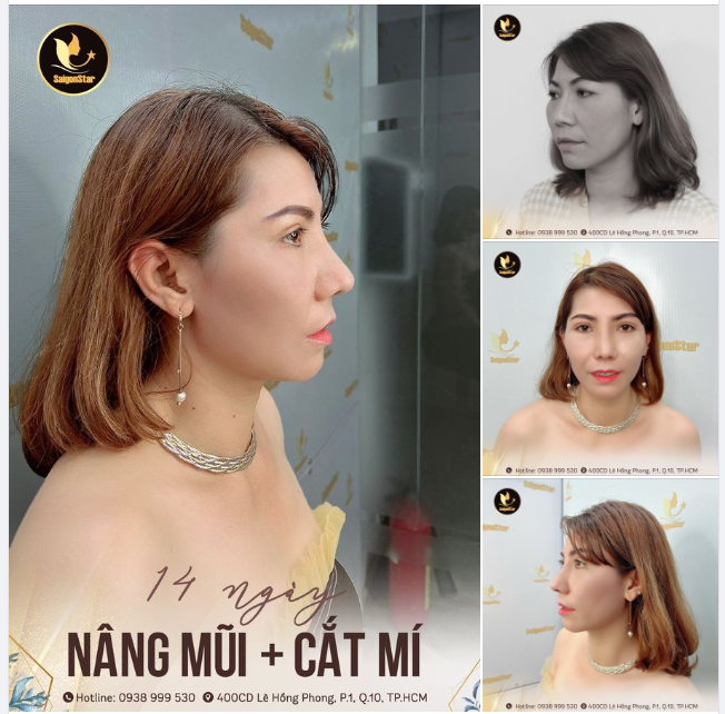 14 NGÀY NÂNG MŨI CẤU TRÚC + CẮT MÍ DR. HOẠT DÁNG MŨI + DÁNG MÍ HOÀN HẢO ĐẾN TỪNG CHI TIẾT