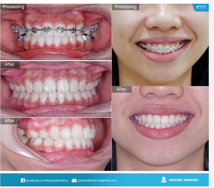  CHỈNH HÔ KẾT HỢP  ĐÁNH LÚN CHỮA CƯỜI HỞ LỢI