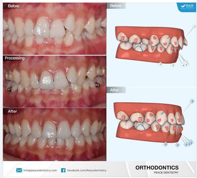 Ca lâm sàng chỉnh nha invisalign cho trường hợp răng chen chúc (khấp khểnh) với thời gian 24 tháng