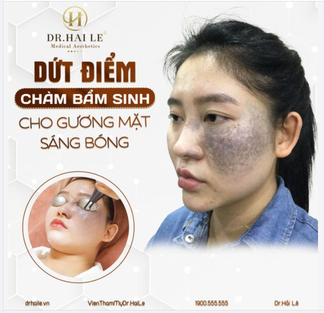 Gương mặt khả ái nhưng chỉ vì mảng chàm bẩm sinh kia mà biến nhan sắc của bạn kém duyên đi rất nhiều.