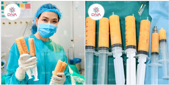 TIÊM MỠ COLEMAN VÀ NHỮNG LỢI ÍCH CÓ THỂ BẠN CHƯA BIẾT