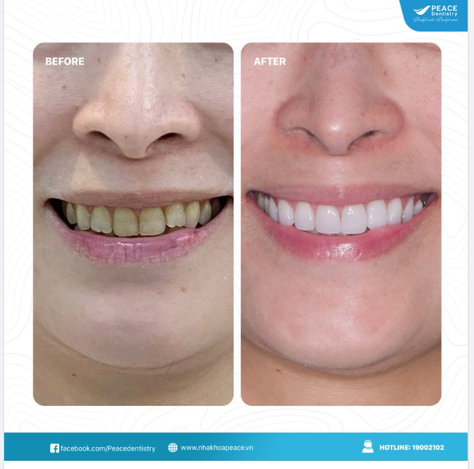 Ca lâm sàng Veneer với mong muốn chính yếu từ khách hàng "đẹp tự nhiên, hạn chế việc mài răng và ăn uống thoải mái".