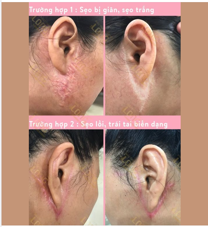 MUỐN TRẺ ĐẸP NHƯNG SỢ SẸO XẤU SAU KHI CĂNG DA MẶT