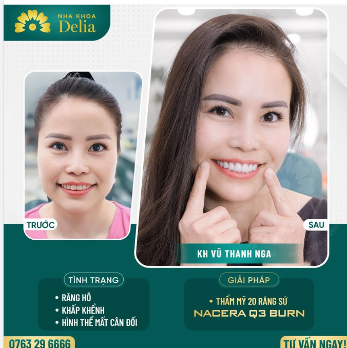 Bọc răng sứ - Kiến tạo nụ cười đều đẹp, tự tin