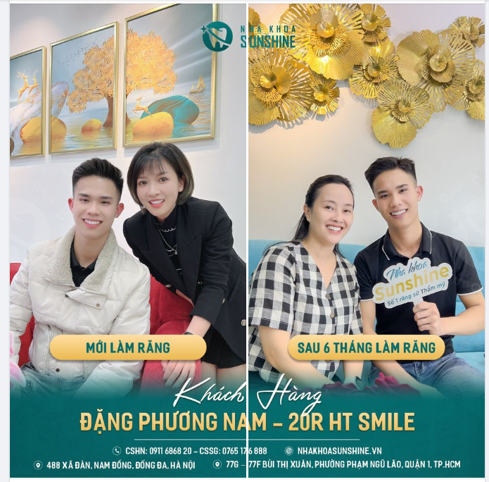 Khách hàng Việt kiều ĐẶNG PHƯƠNG NAM – sau 6 tháng làm răng sứ chính hãng tại Sunshine là minh chứng cho điều đó