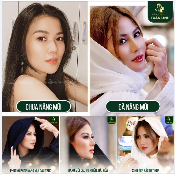 Loại bỏ hoàn toàn mọi loại khuyết điểm ''đáng ngại'' trên mũi cũ, lên dáng mũi mới đẹp hoàn hảo.