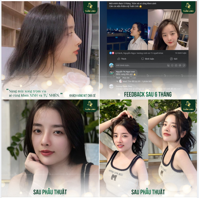 '' Nâng mũi xong ai cũng khen XINH...Mình rất vui. Trước đây mình tự ti về chiếc mũi của mình lắm, nhưng bây giờ thì đã tự tin hơn rất nhiều rồi " - Khách hàng M.T chia sẻ sau 6 tháng nâng mũi!!