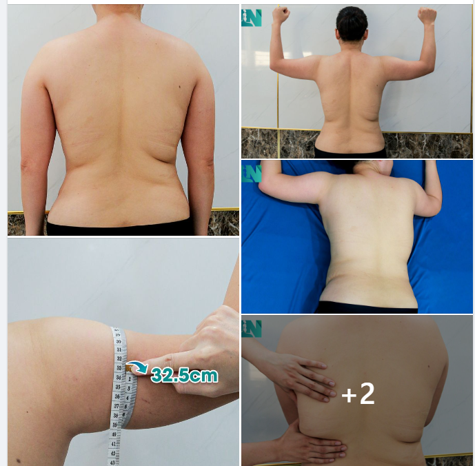  HÚT MỠ TẠO DÁNG THẨM MỸ VÙNG TAY, LƯNG, NÁCH CHO CHỊ KH 9X, ĐÃ HÚT MỠ BỤNG TẠI EKIP 3 NĂM TRƯỚC. 