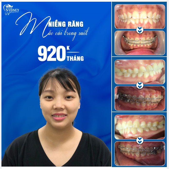 THAY ĐỔI DIỆN MẠO CÙNG VỚI MẮC CÀI TRONG SUỐT