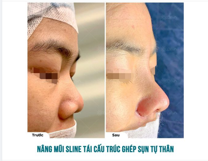 CẢI THIỆN SỐNG MŨI THẤP, CÁNH MŨI TO VỚI NÂNG MŨI SLINE TÁI CẤU TRÚC