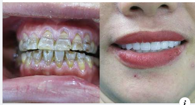Trường hợp nào nên chọn dán sứ Veneer ?
