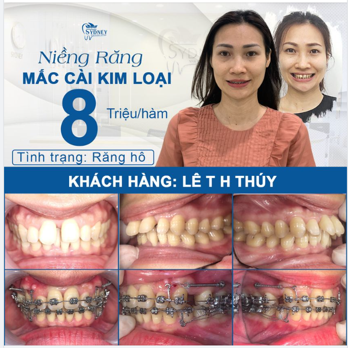 ẢNH HƯỞNG CỦA RĂNG HÔ?
