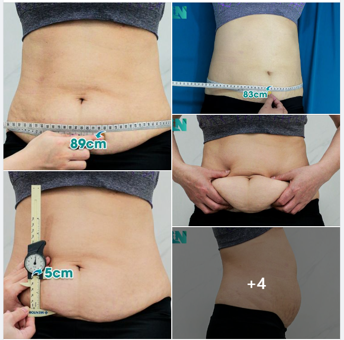 HÚT MỠ TẠO DÁNG THẨM MỸ VÙNG BỤNG 7X, ƯỚC MONG DÁNG VÓC GỌN THON TỪ NHIỀU NĂM TRƯỚC, QUYẾT ĐỊNH THỰC HIỆN GIẢM MỠ AN TOÀN.