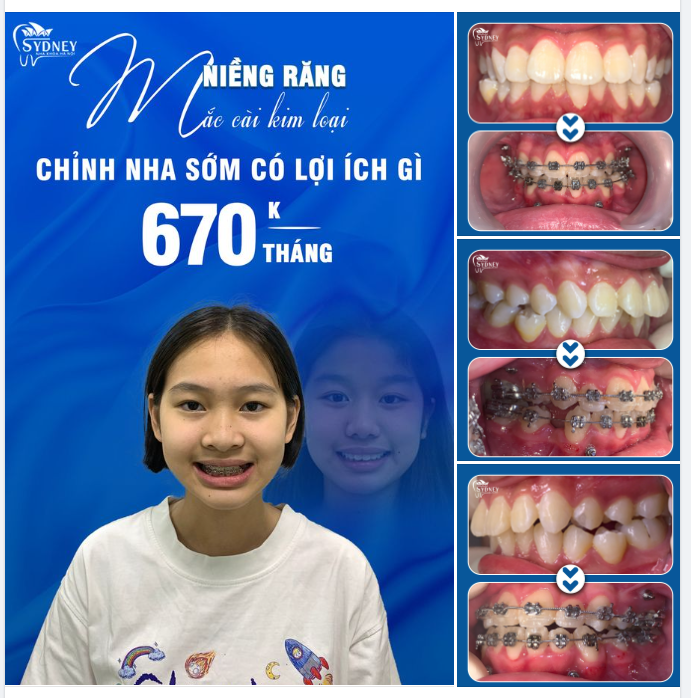 TÌM LẠI KHỚP CẮN CHUẨN SỚM CHO CON BỐ MẸ NHÉ!