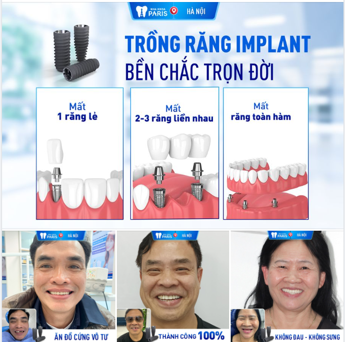 GIẢI PHÁP TỐT NHẤT CHO NGƯỜI MẤT RĂNG