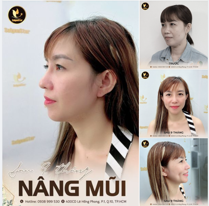 Update liên tục kết quả của khách hàng để chị em có thêm động lực làm đẹp!!