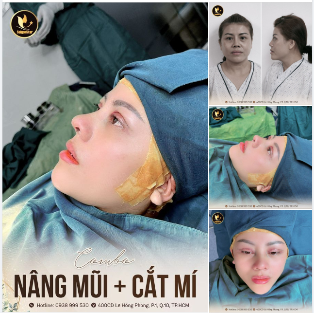 COMBO NÂNG MŨI + CẮT MÍ THAY ĐỔI SẮC DIỆN MỘT CÁCH TOÀN DIỆN