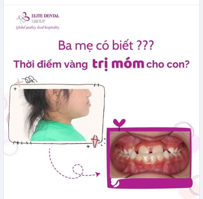 RĂNG MÓM Ở TRẺ EM MỘT VẤN ĐỀ CẦN GIẢI QUYẾT SỚM