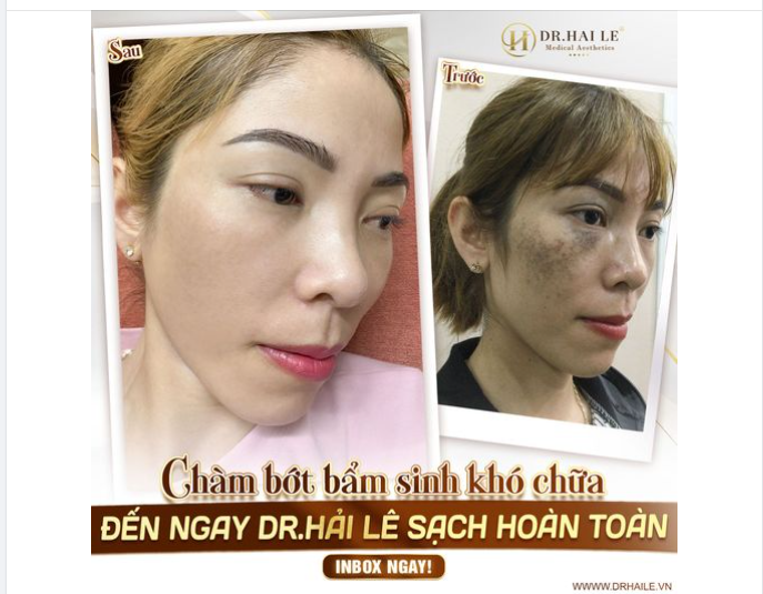 Những vết chàm, bớt bẩm sinh ở mặt luôn là nguyên nhân khiến người mắc cảm thấy mặc cảm với xã hội.