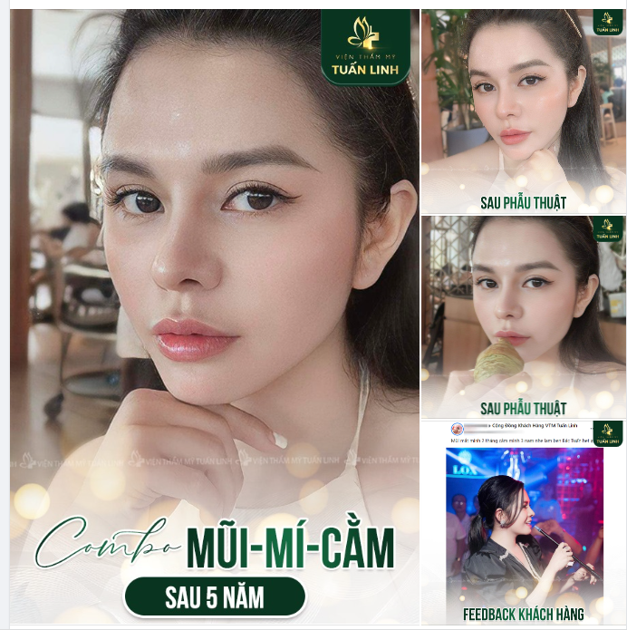 COMBO MŨI -MÍ - CẰM SAU 5 NĂM LÀM TẠI TUẤN LINH