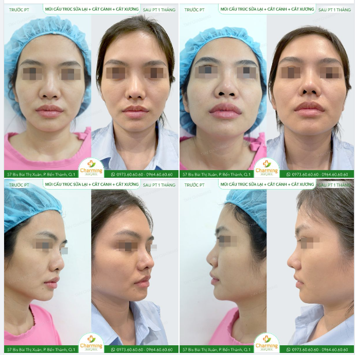 Chiếc mũi từng phẫu thuật qua nhưng chỉ có phần trên sóng mũi được cải thiện, còn độ hếch mũi thì.... bó tay.