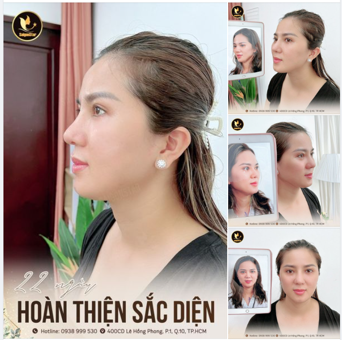 NÂNG MŨI CẤU TRÚC – SỬA LẠI MŨI LỆCH