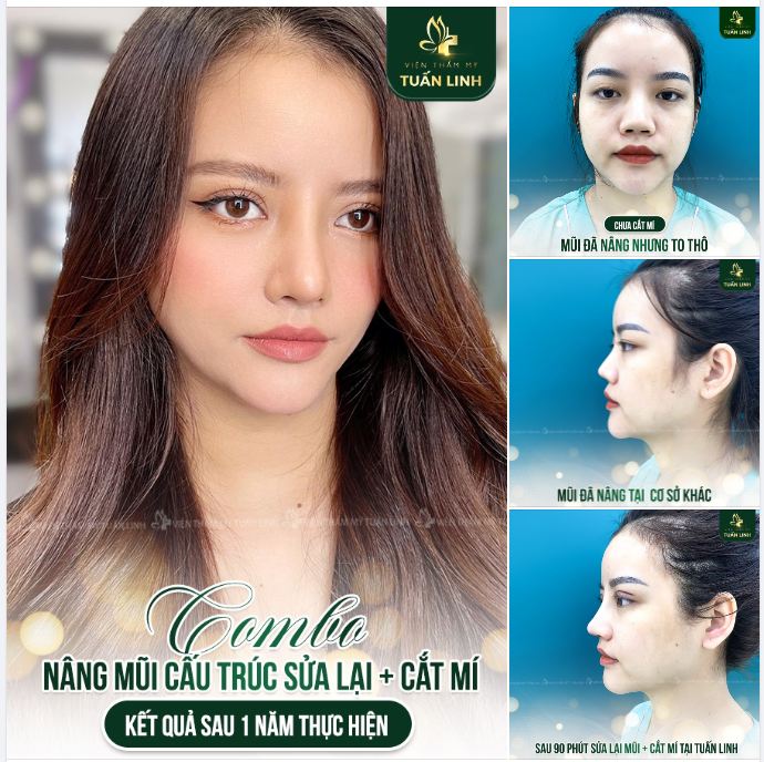 COMBO Mũi cấu trúc sửa lại + cắt mí sau hơn 1 năm thực hiện tại Tuấn Linh!