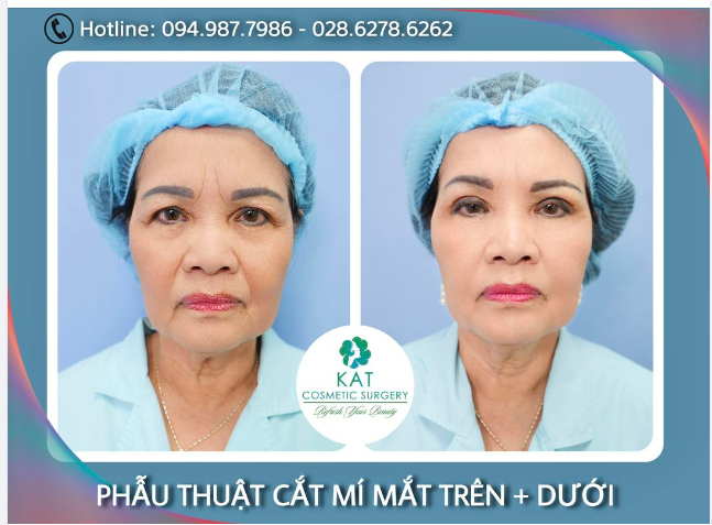 Khi lão hóa, da mí mắt sẽ chùng xuống, những cơ nâng đỡ mí mắt yếu đi, mỡ thừa hội tụ khiến cho mí mắt trên chảy xệ.