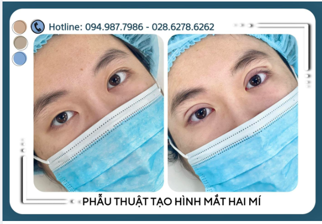 BẤM MÍ : Sự lựa chọn hoàn hảo cho các cô nàng có ít da dư và mỡ thừa, những cô nàng mắt một mí, nhiều mí lót nhưng vẫn muốn sở hữu đôi mắt hai mí to tròn.