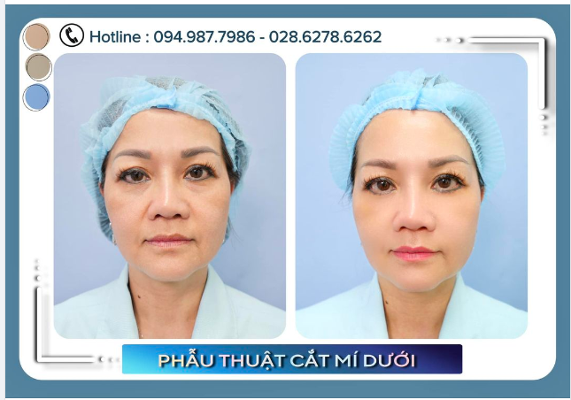 Phương pháp cắt mí mắt dưới ứng dụng cho những trường hợp cụ thể như: