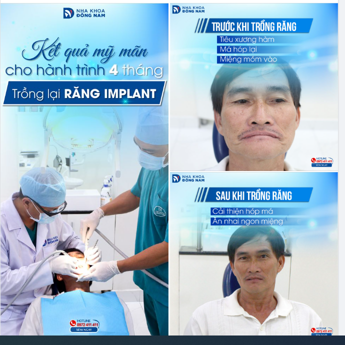 HẠNH PHÚC VỠ ÒA NGÀY GẮN RĂNG IMPLANT HOÀN TẤT