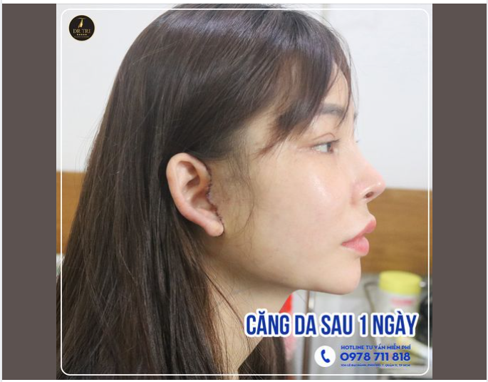 CĂNG DA V-LINE SAU 1 NGÀY tại Dr Trí