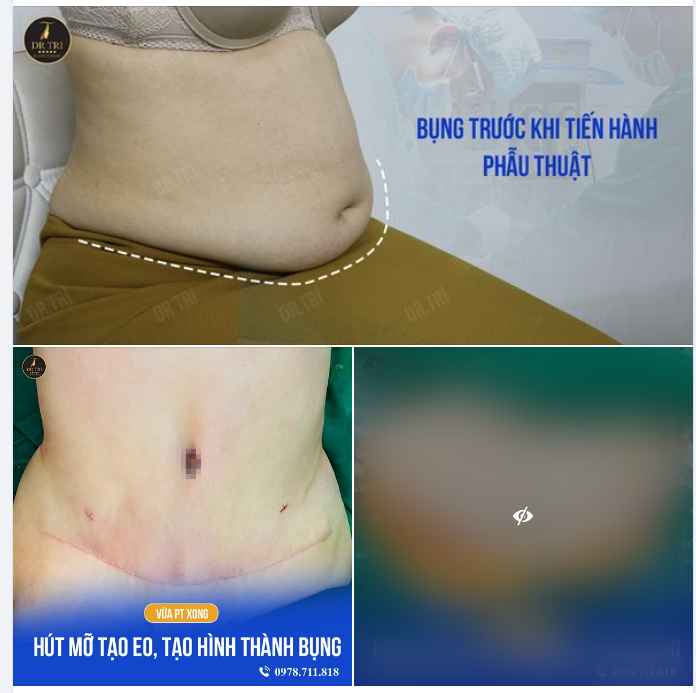 LOẠI BỎ TẢNG MỠ TỒN ĐỌNG THEO THỜI GIAN CHO KHÁCH BỤNG PHỆ