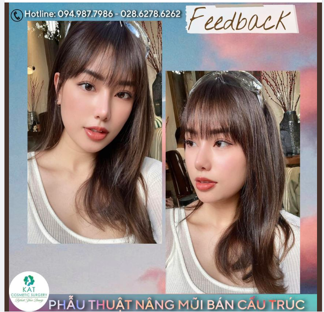 Feedback từ một bạn khách thương yêu của KAT . Dáng mũi cao thanh thoát tự nhiên tuy “sửa như không sửa”. Sau nhiều năm vẫn là dáng mũi luôn được các bạn khách rất yêu thích .