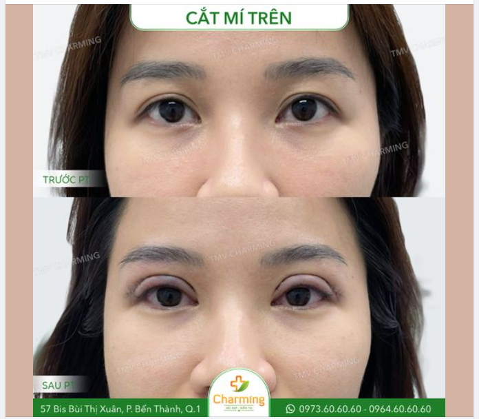 Dù đôi mắt vẫn còn sưng đỏ nhưng chúng ta vẫn thấy rõ được sự thay đổi trước và sau khi cắt mí trên của nàng khách tại Charming.