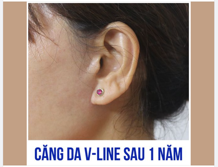 CĂNG DA V-LINE KHÔNG SẸO