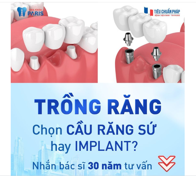 SO SÁNH TRỒNG RĂNG IMPLANT VÀ CẦU RĂNG SỨ