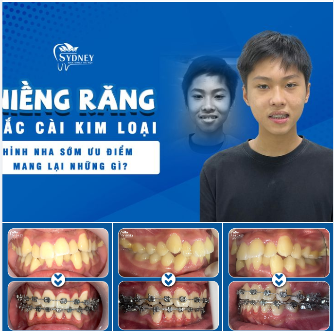 VÌ SAO NÊN NIỀNG RĂNG SỚM CHO CON?