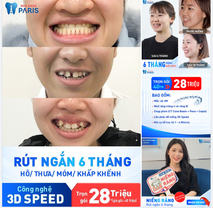 Niềng Răng Rút Ngắn 6 Tháng