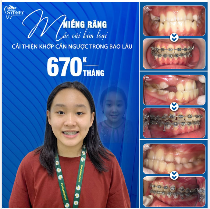 NIỀNG RĂNG CẢI THIỆN KHỚP CẮN NGƯỢC TRONG BAO LÂU?