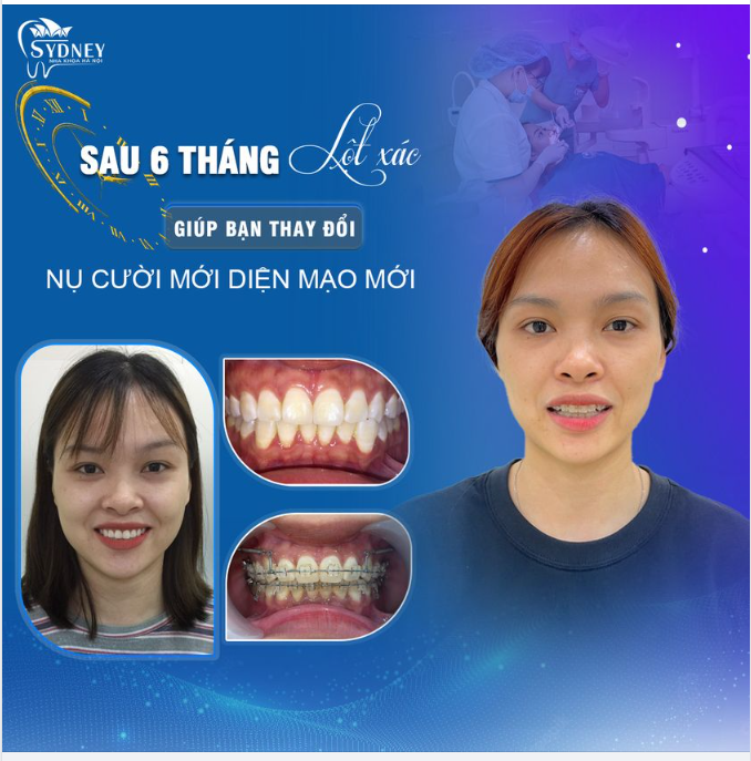 GIẢI ĐÁP THẮC MẮC VỀ NIỀNG RĂNG?