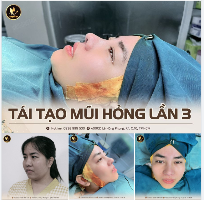 GIẢI CỨU MŨI HỎNG LẦN 3