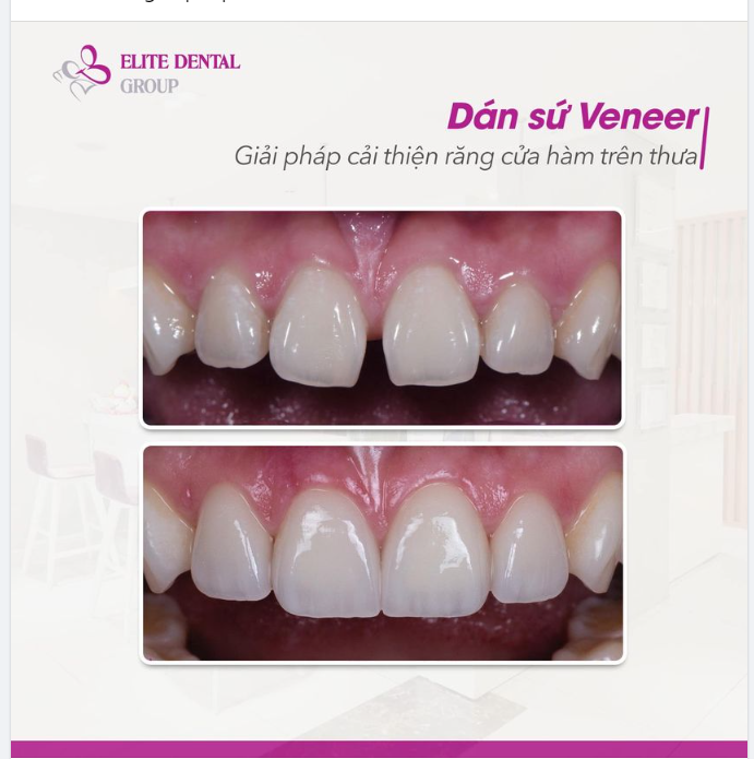 Cải thiện hình dáng răng thưa, có khoảng hở bằng phương pháp dán sứ Veneer