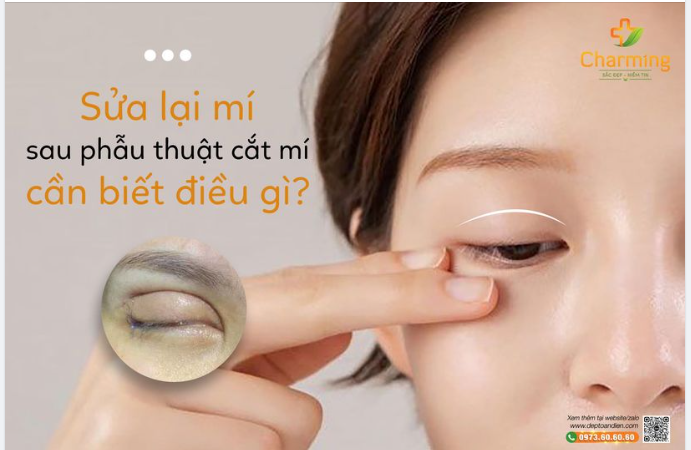 KHI MUỐN SỬA LẠI MÍ SAU PHẪU THUẬT CẮT MÍ BẠN CẦN BIẾT ĐIỀU GÌ?