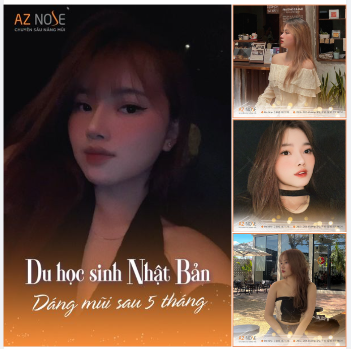 "Nếu không nâng mũi bây giờ, thì là bao giờ?"