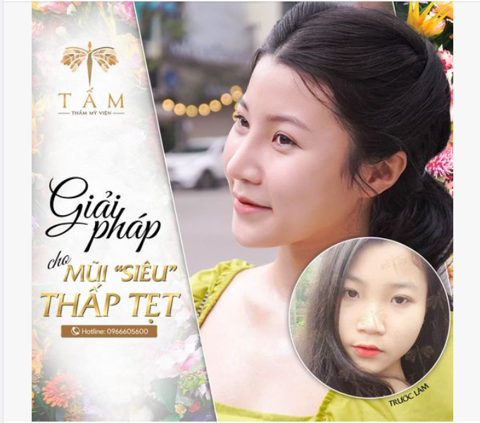 Mũi tẹt là chiếc mũi có phần sống mũi thấp, xương mũi to bè, đầu mũi lớn, lỗ mũi rộng. Thông thường mũi bị tẹt làm cho tổng thể của chiếc mũi ngắn, có tình trạng hếch lộ rõ lỗ mũi.
