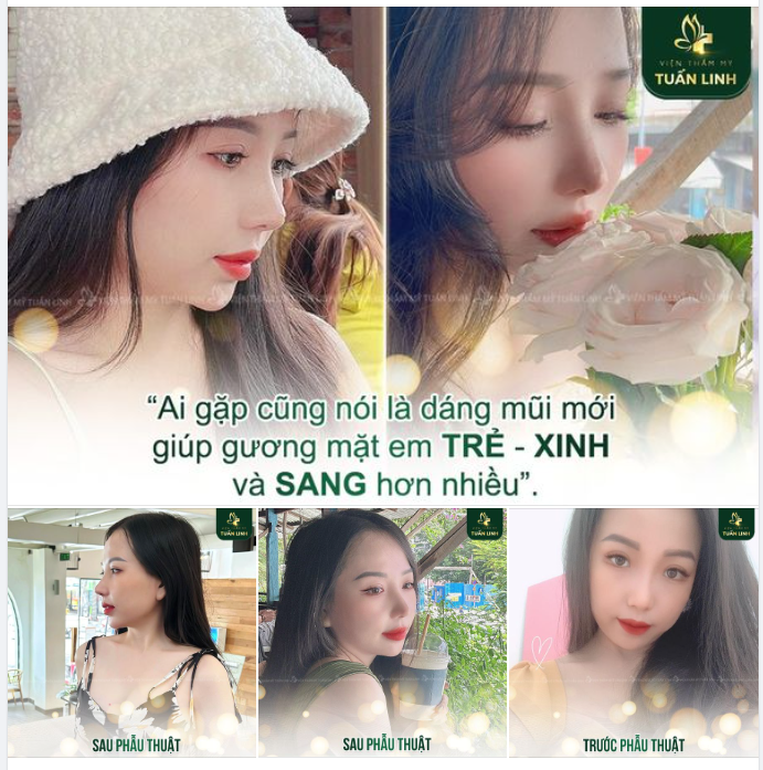 "Từ khi nâng mũi, thần thái trở nên sang xịn hơn hẳn!!"