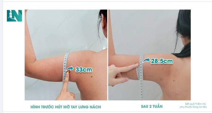 VÙNG CÁNH TAY SAU GIẢM MỠ SẼ NHƯ THẾ NÀO?
