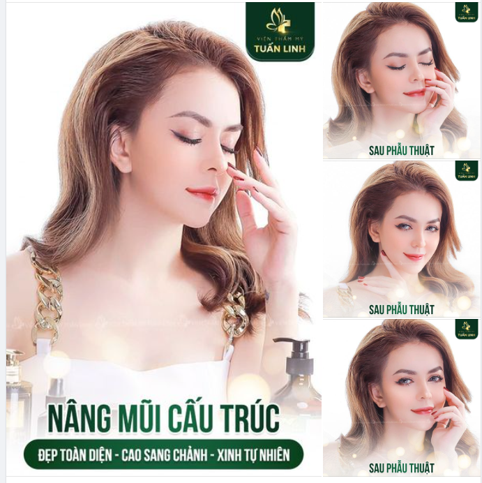 Nâng mũi cấu trúc  - Đẹp toàn diện - Xinh tự nhiên