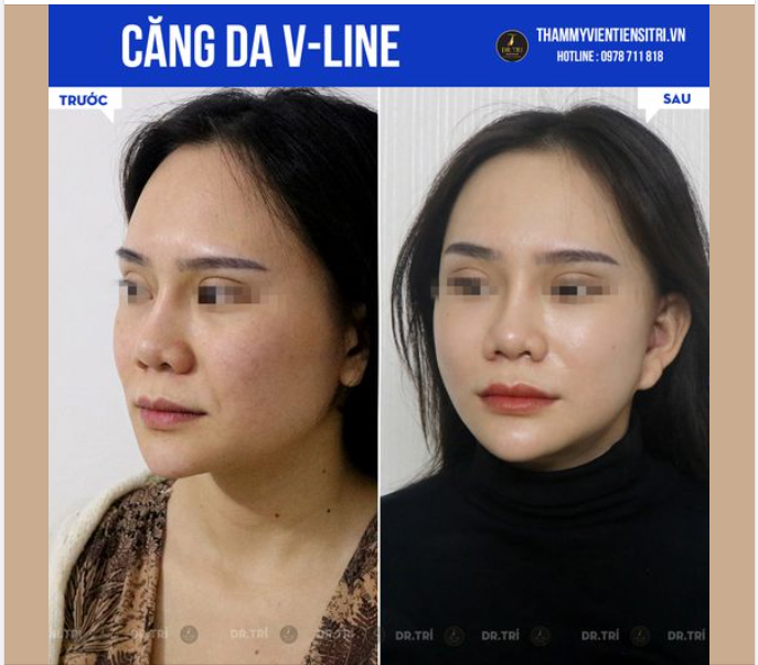 HÌNH ẢNH CĂNG DA V-LINE TRẺ HÓA GƯƠNG MẶT SAU 6 THÁNG ỔN ĐỊNH